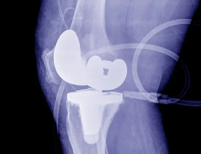 Reemplazo total de rodilla